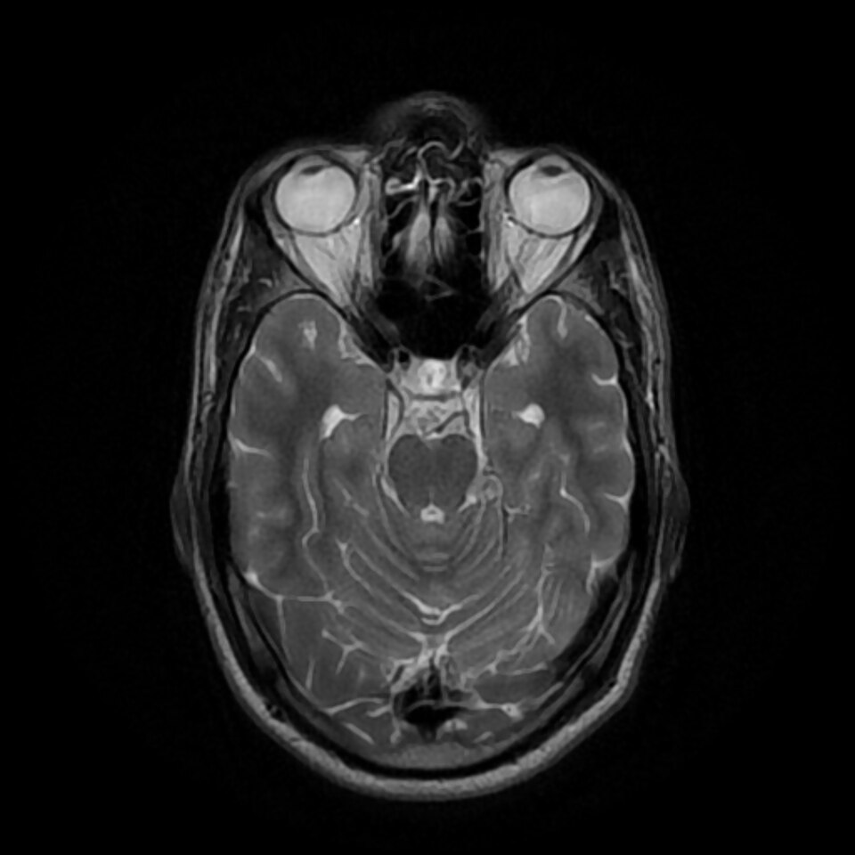 Neurosurgery